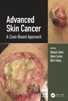 کتاب Advanced Skin Cancer