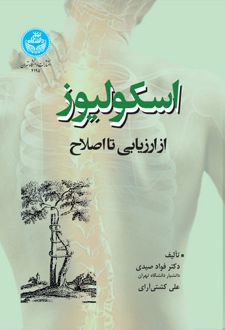 اسکولیوز