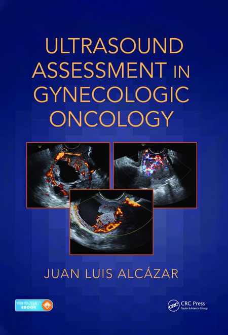 Ultrasound Assessment in Gynecologic Oncology