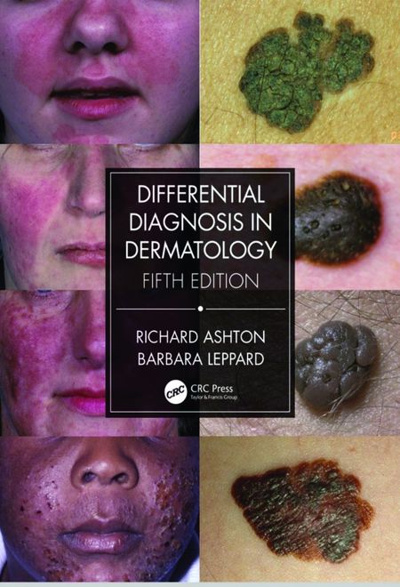 Differential Diagnosis in Dermatology